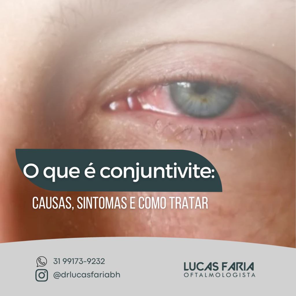 O Que Conjuntivite Causas Sintomas E Como Tratar Lucas Tavares Faria